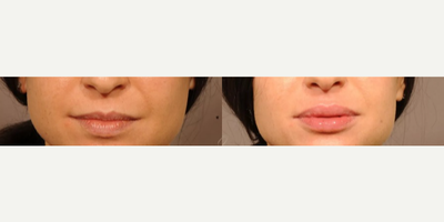 Lip Fillers before and after photo