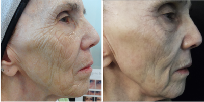 Microneedling before and after photo