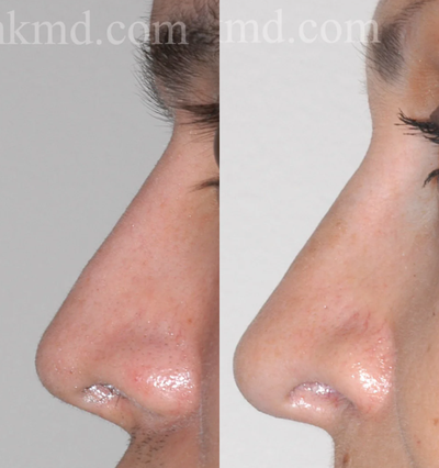 Revision Rhinoplasty before and after photo
