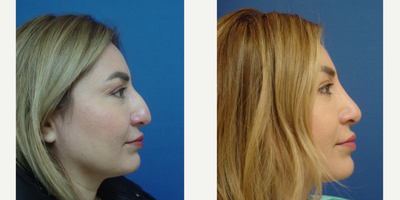 Rhinoplasty before and after photo