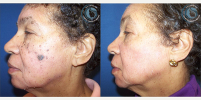 Skin Rejuvenation before and after photo