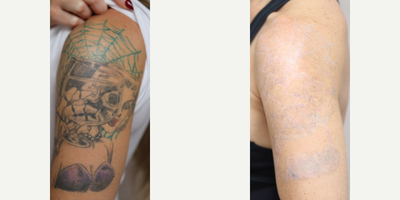 Tattoo Removal before and after photo