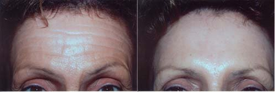 Botox before and after photo