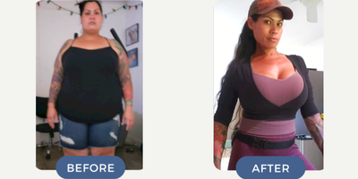 Breast Lift with Implants before and after photo