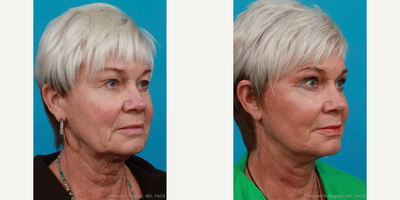 Facelift before and after photo