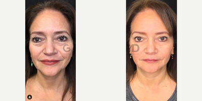 FaceTite before and after photo