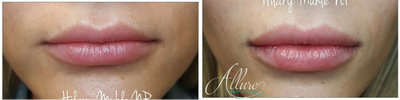 Juvederm before and after photo