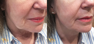 Nonsurgical Facelift before and after photo