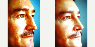 Rhinoplasty before and after photo