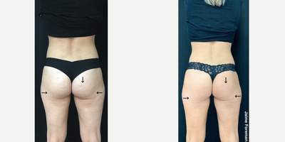CoolTone before and after photo