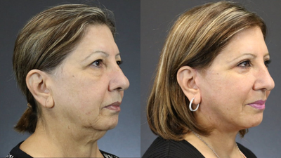 Facelift before and after photo