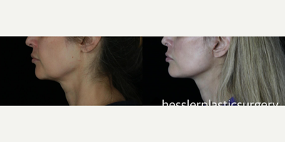 Facelift before and after photo