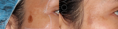 PicoSure before and after photo