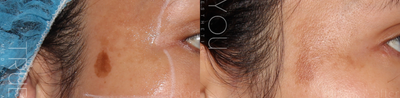 PicoSure before and after photo