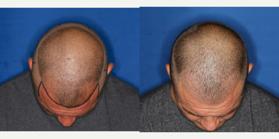 ARTAS Robotic Hair Transplant before and after photo
