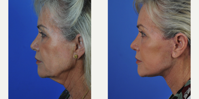 Facelift before and after photo