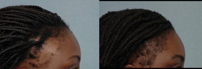 Hair Transplant before and after photo