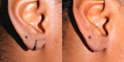 Skin Rejuvenation before and after photo