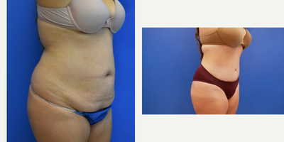 Tummy Tuck before and after photo