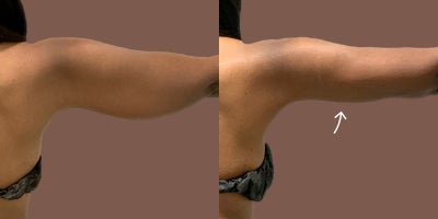 AirSculpt before and after photo