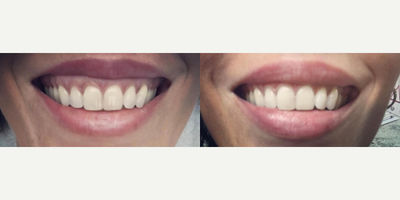 Botox before and after photo