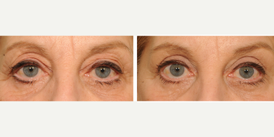 Eyelid Surgery before and after photo