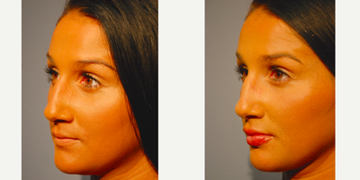 Lip Fillers before and after photo