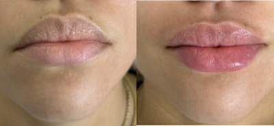 Lip Fillers before and after photo