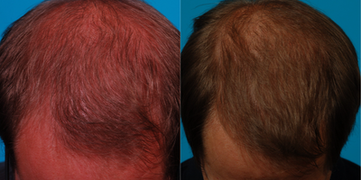 PRP for Hair Loss before and after photo