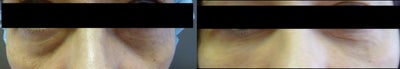 Restylane before and after photo