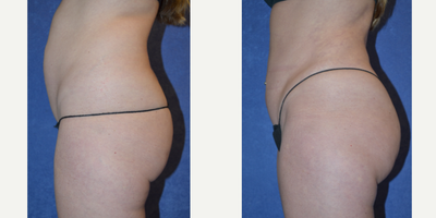 Tummy Tuck before and after photo