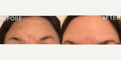 Botox before and after photo