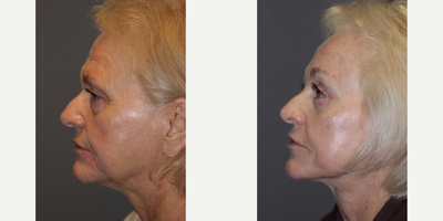 Facelift before and after photo