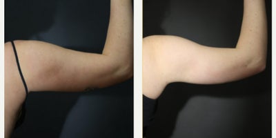 Liposuction before and after photo