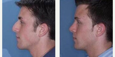 Rhinoplasty before and after photo