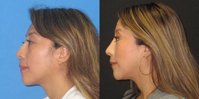 Rhinoplasty before and after photo