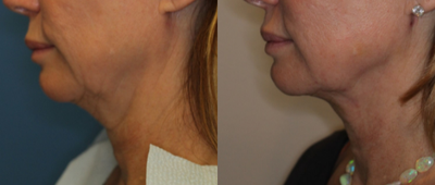 Skin Tightening before and after photo