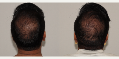 FUE Hair Transplant before and after photo