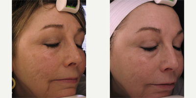 Microneedling before and after photo
