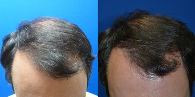 PRP for Hair Loss before and after photo