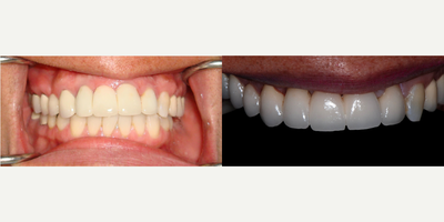 Smile Makeover before and after photo
