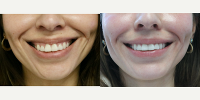 Botox before and after photo