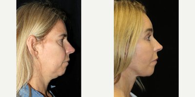 Deep Plane Facelift before and after photo