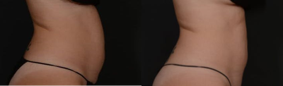 Emsculpt before and after photo