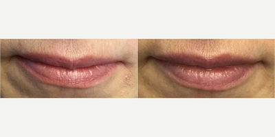 Lip Fillers before and after photo