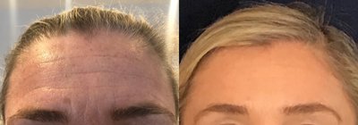 Botox before and after photo