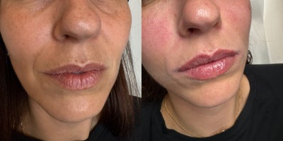 Botox before and after photo