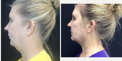 CoolSculpting before and after photo
