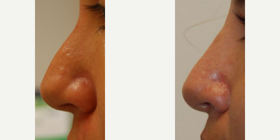 Dermal Fillers before and after photo
