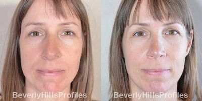 Rhinoplasty before and after photo